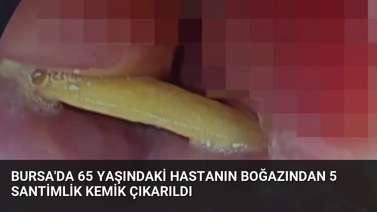 Bursa’da 65 Yaşındaki Hastanın Boğazından 5 Santimlik Kemik Çıkarıldı