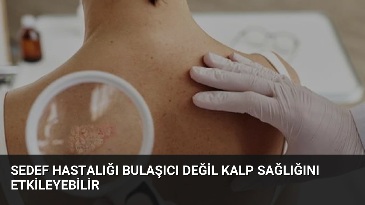 Sedef Hastalığı Bulaşıcı Değil Kalp Sağlığını Etkileyebilir